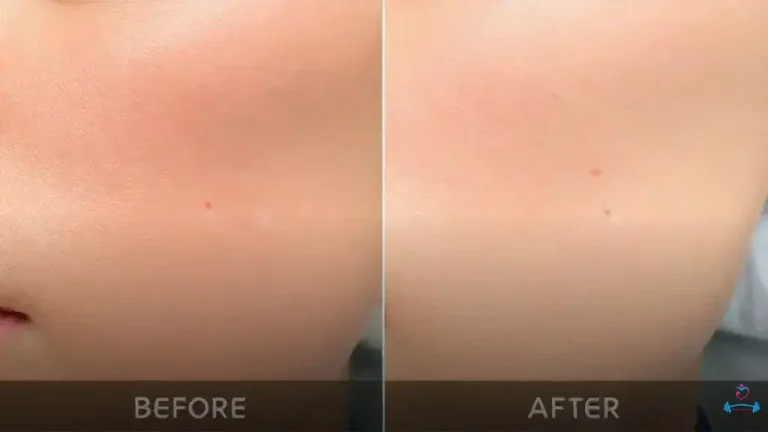 tratamento para estrias branca antes e depois